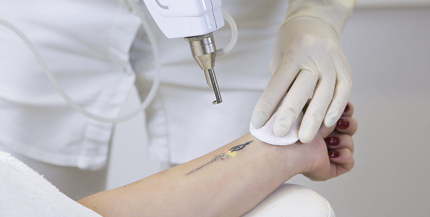 image-tatoo-removal Remoção de Tatuagem